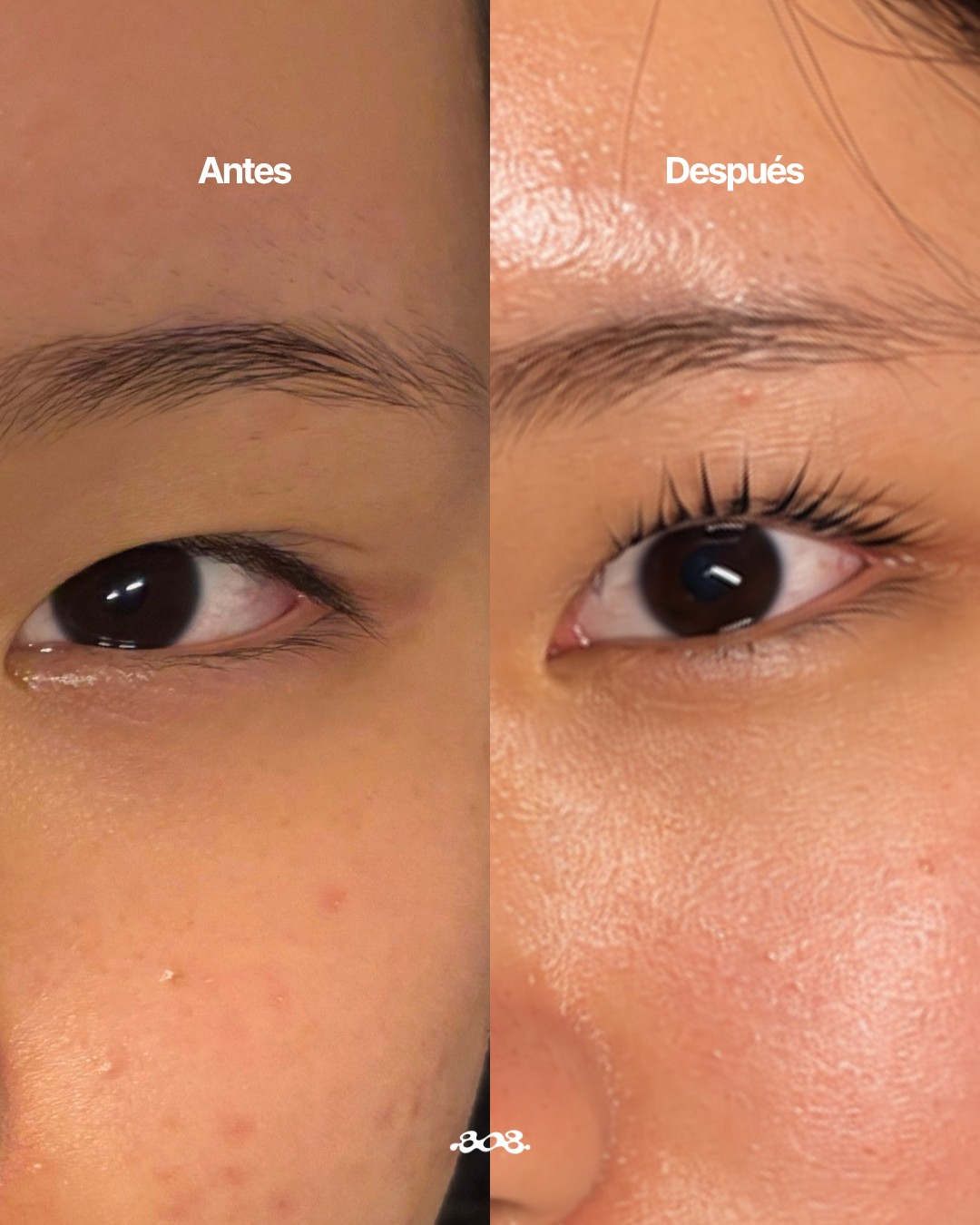 Antes y después de lifting